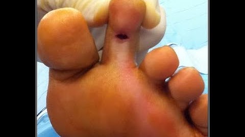 Tenotomy Toe CPT code - simplify medical coding