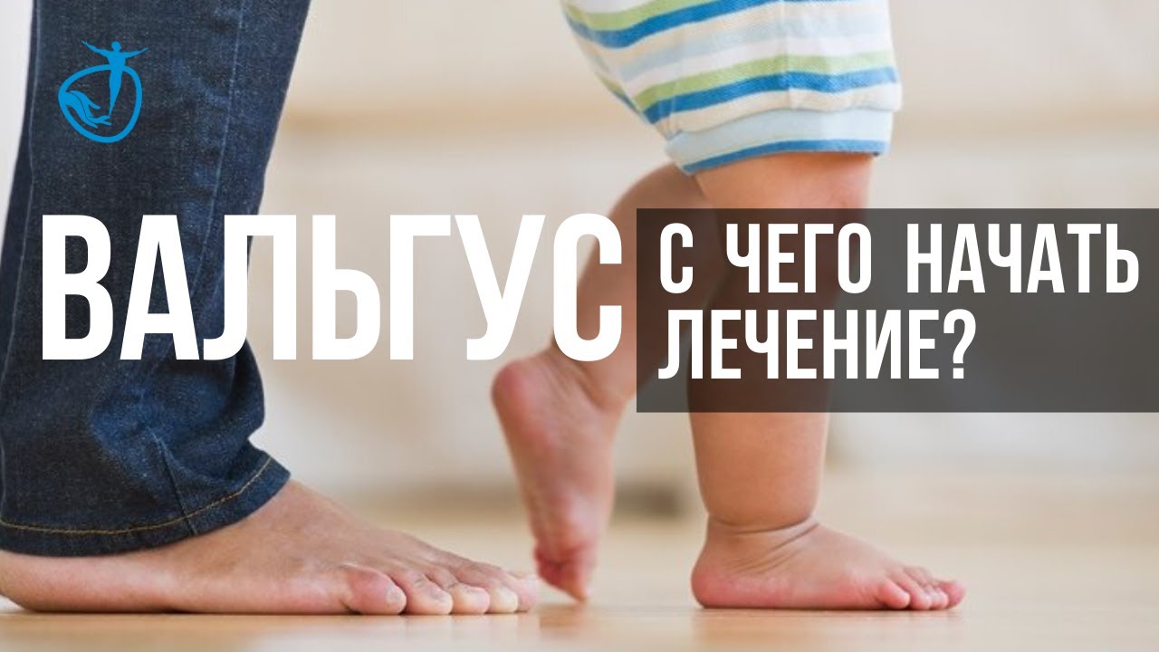 ВАЛЬГУС - С ЧЕГО НАЧАТЬ ЛЕЧЕНИЕ и к какому врачу идти? - YouTube