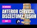 Anterior Cervical Discectomy and Fusion (ACDF) - 3D Animation