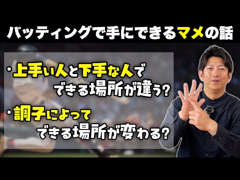 バッティングで手にできるマメの話（後半で投球でできるマメの話も）