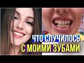 3 года ПОСЛЕ СНЯТИЯ БРЕКЕТОВ // ЧТО СЛУЧИЛОСЬ С МОИМИ ЗУБАМИ