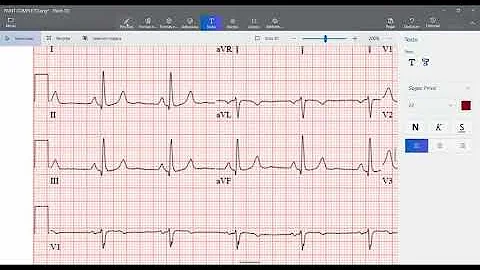 ¿Puede un ECG detectar la insuficiencia cardíaca?