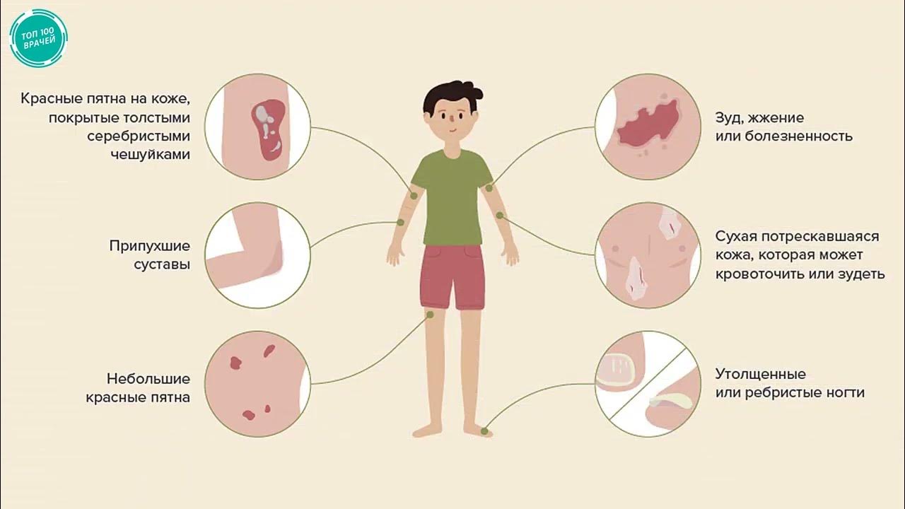 Причины зуда тела у пожилых. Начальные симптомы псориаза. Кожное заболевание псориаз.