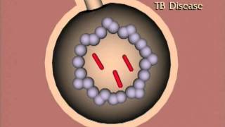 Mantoux TB Skin Test 2