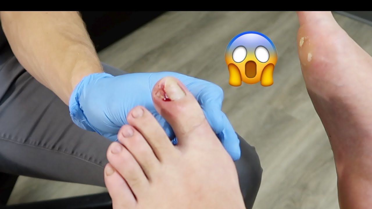 Ingrown Toenail Treatment & Surgery Wart & Foreign Body Removal 4