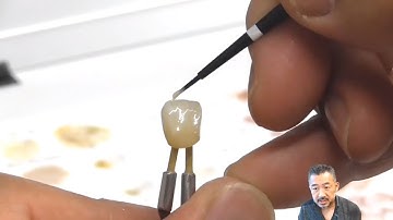Monolithic zirconia crowns : FROM DESIGN TO STAIN TECHNIQUES