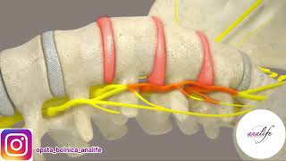 Kako Rešiti Diskus Herniju