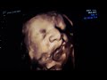 Dad Recognizes Baby&#39;s Face In Ultrasound, Learns Mom Lied