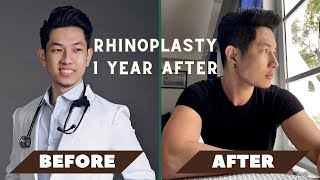 MY RHINOPLASTY & CHIN AUGMENTATION JOURNEY | Dr. Henry Claravall & Dr. Romeo Bato