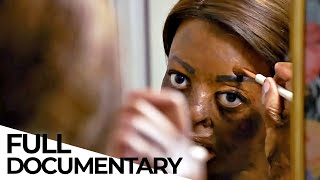 Living with a Facial Disfigurement | My Extreme Life | ENDEVR Documentary