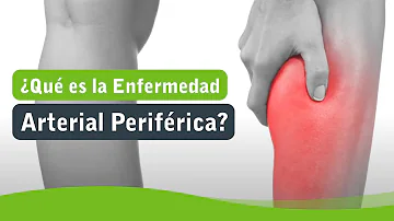 ¿La arteriopatía periférica duele siempre?