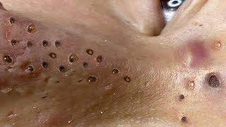 Loan Nguyen Acne Treatment 4.
