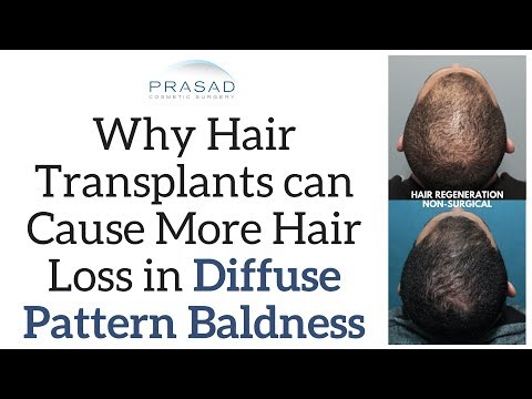 Why Hair Transplants can Cause More Hair Loss in Diffuse Hair Thinning, and Alternative Treatments