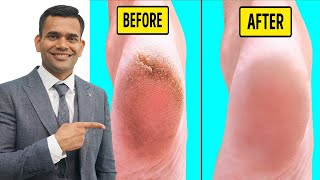 fix cracked heels fast | homemade cream to treat cracked heels naturally screenshot 4