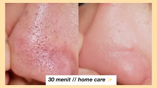 Cara Menghilangkan Komedo // gentle for skin (no pore strip)