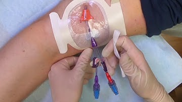 SecurAcath Dressing Change with Standard Tegaderm