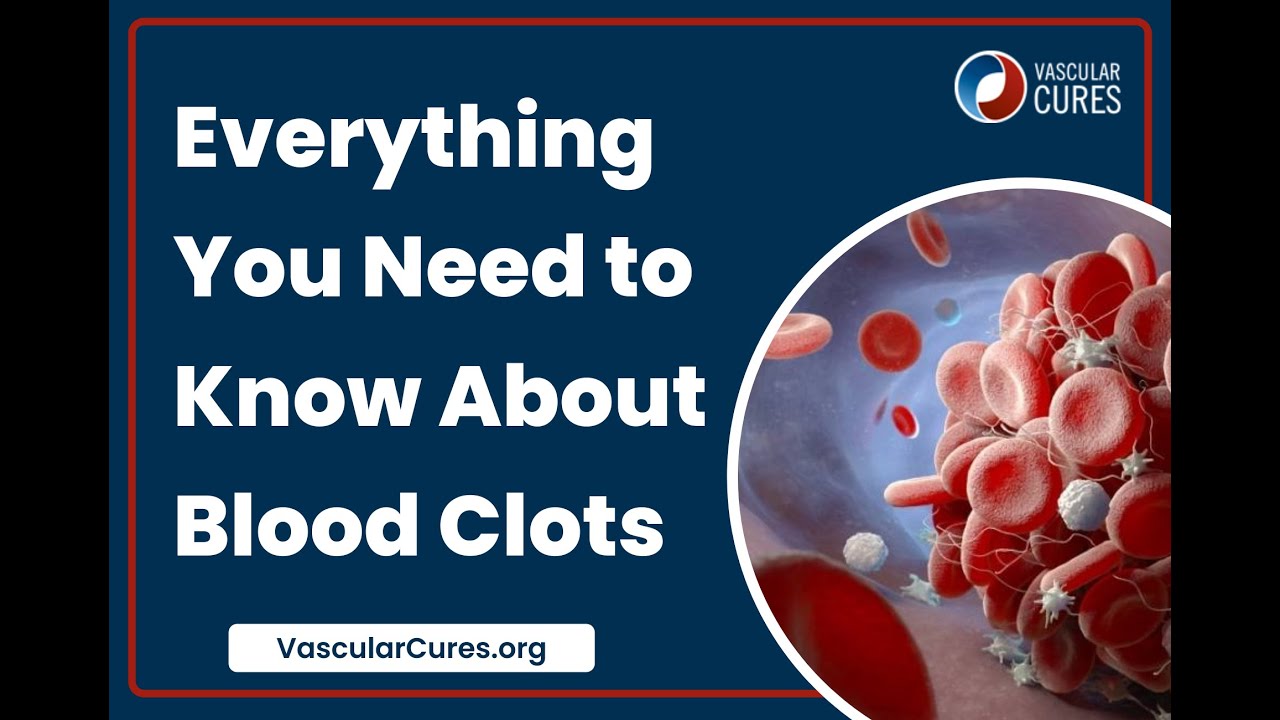 Everything You Need to Know About Blood Clots YouTube