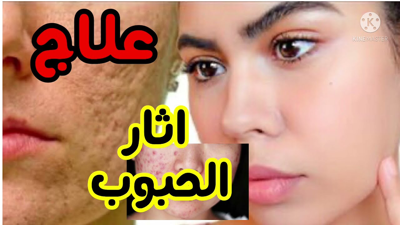 طاكسي المعرفة وصفة علاج اثار الحبوب و تصفية و تبيض الوجه