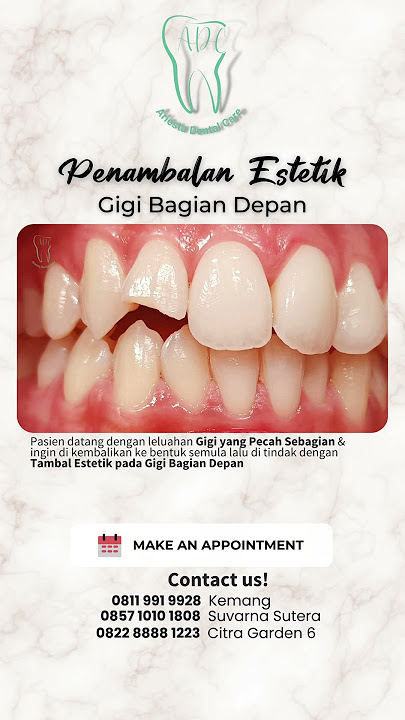 Penambalan Estetik pada Gigi Depan. Yess Looks Gorgeous On You ! #klinikgigijakarta #dental #smile