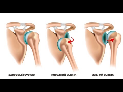 Вопрос: Как вправить вывих плеча?