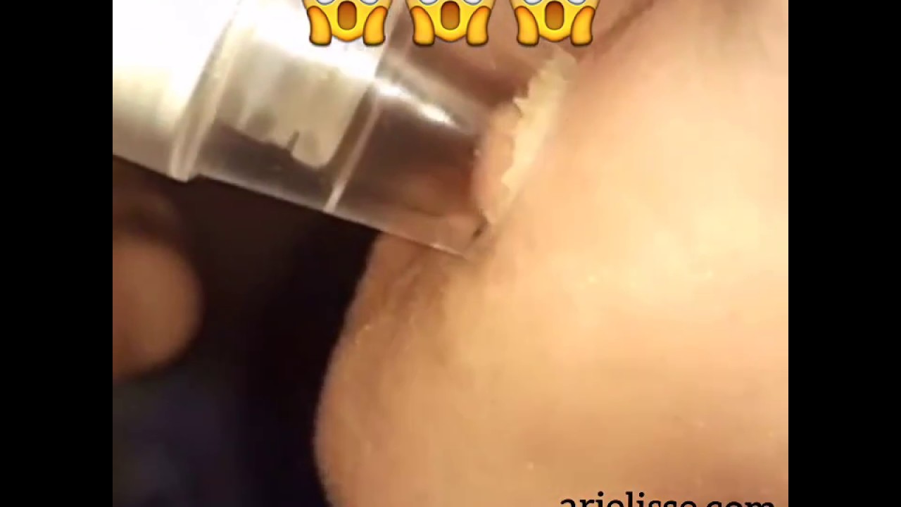 Blackhead Remover Vacuum Pore Suction Device