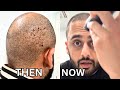 Shaving my head bald 3 years after hair transplant