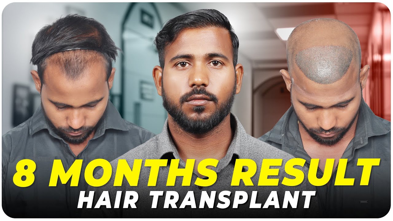 Hair Transplant in Madurai Best Results & Cost of Hair Transplant in