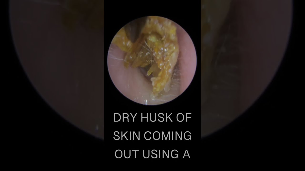 DRY EAR WAX HUSK REMOVAL