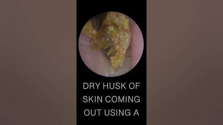 DRY EAR WAX HUSK REMOVAL