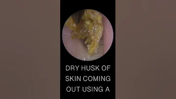 DRY EAR WAX HUSK REMOVAL 