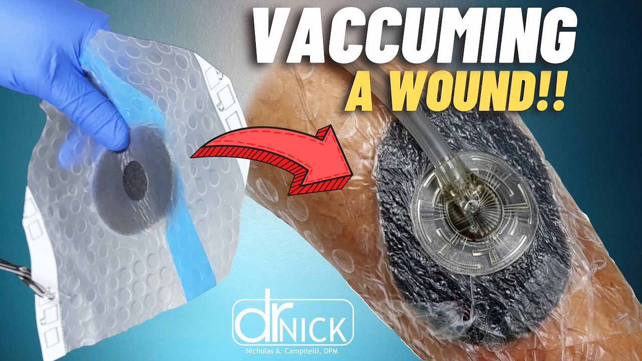 How To Apply A Wound Vac! YouTube
