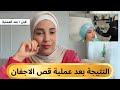 حمزة وسمر النتيجة بعد قص الأجفان نصيحتي من التجربة