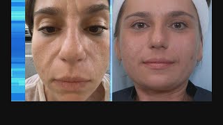 Watch Our Galvanic Facial Loved by Celebrities like Hilary Duff and Mandy Moore