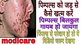 चेहरे से कील मुंहासे हटाने के उपाय / modicare products/ jyoti rawat/ rishikesh