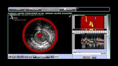 Using TVC Imaging System to Determine Treatment Strategy for STEMI