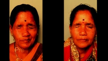 AIOC2018 - IC532 - Topic - Functional Indications : Facial Spasms - Dr.Milind Naik