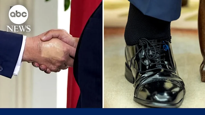 What is chronic venous insufficiency? Everything to know about Trump's diagnosis