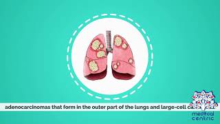 Lung Cancer, Causes, Signs and Symptoms, Diagnosis and Treatment.