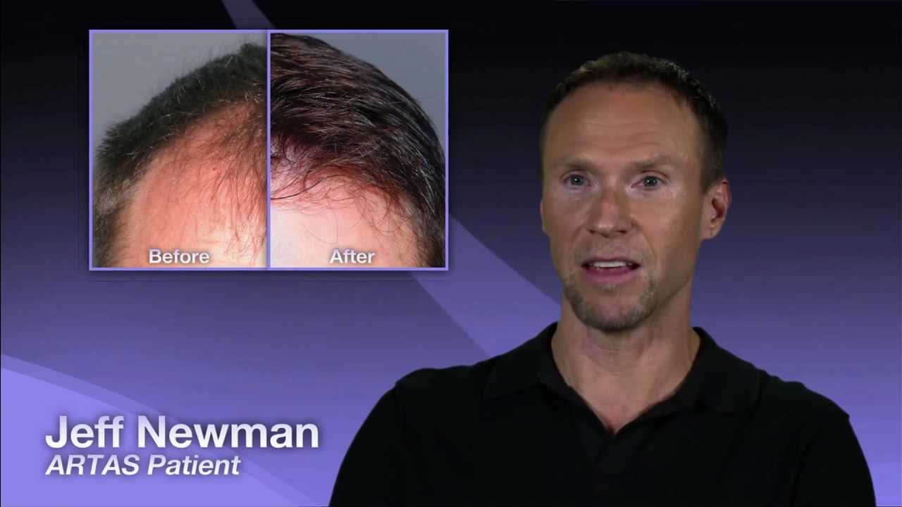 Charles Medical Group (ARTAS Hair Restoration Defined) Video