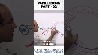 Papilledema Part 02 #drnajeeb #drnajeeblectures #youtubeshorts