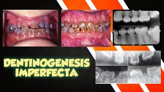 DEVELOPMENTAL ANAMOLIES OF TEETH - DENTINOGENESIS IMPERFECTA