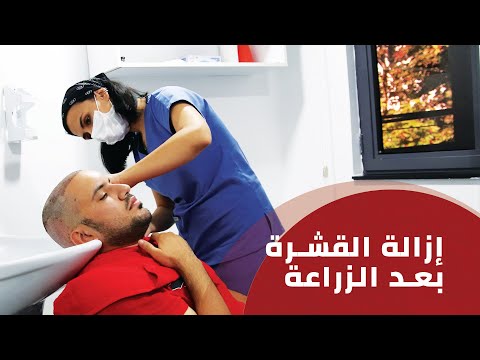 إزالة القشرة بعد عملية زراعة الشعر