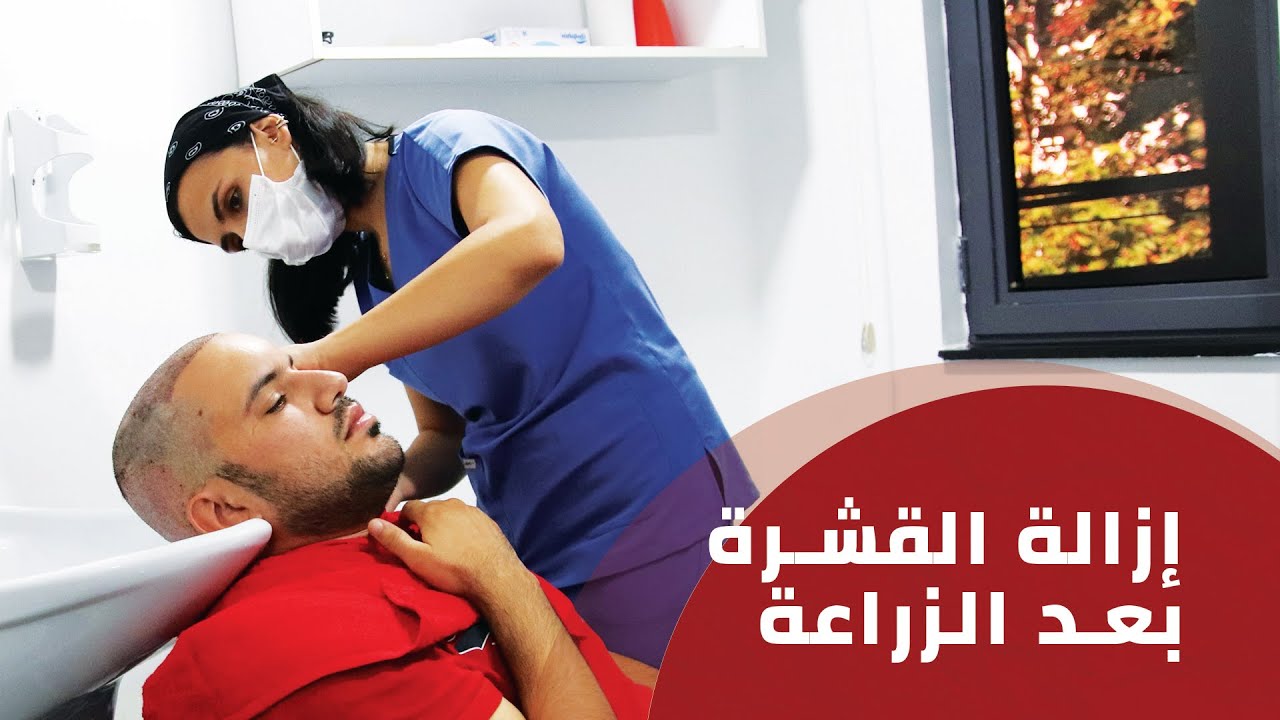 إزالة القشرة بعد عملية زراعة الشعر