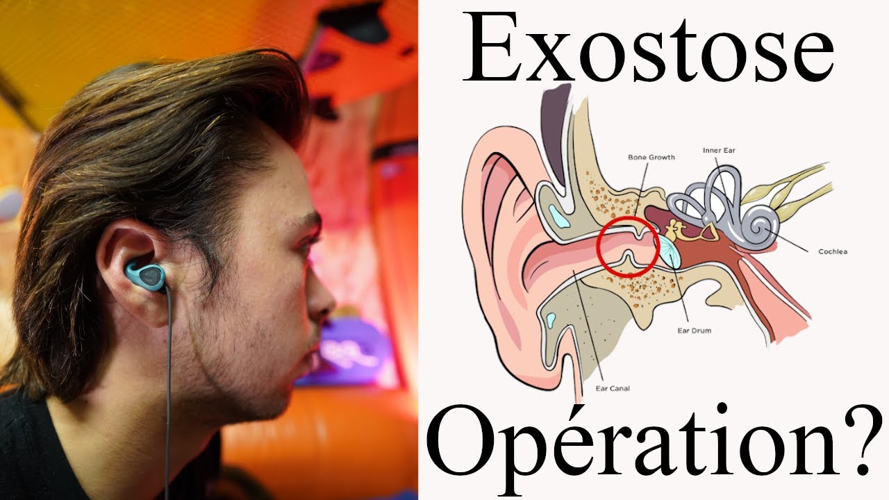 EXOSTOSE les bouchons une solution? (Maladie des surfers) 👂💥 YouTube — free download