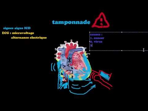 Vidéo: Tamponade Cardiaque: Causes, Symptômes Et Traitement