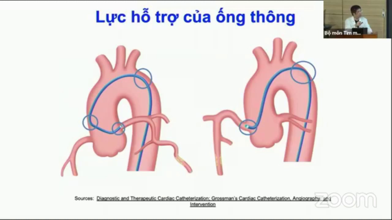 Dụng cụ và can thiệp động mạch vành cơ bản | TIM MẠCH CAN THIỆP (buổi 4) -  YouTube