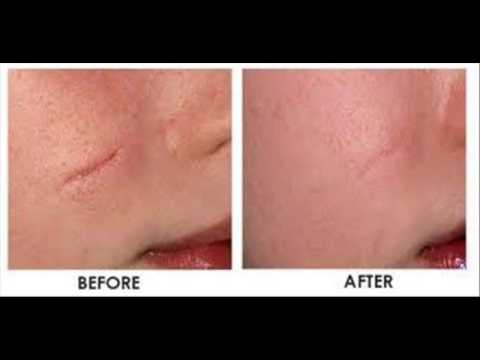 revitol scar cream