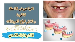 اهمية تعويض الاسنان المفقودة،افضل التعويضات، اضرار عدم التعويض #الاسنان_المفقودة