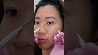 Why Double Eyelid Design Is Never One-Size-Fits-All