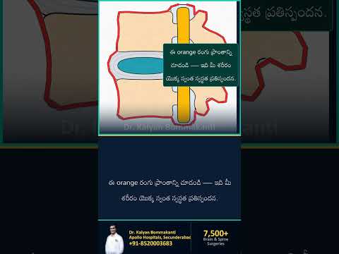 మీ శరీరం స్లిప్ప్డ్ డిస్క్‌ని కరిగిస్తుంది — బెస్ట్ ఎండోస్కోపిక్ స్పైన్ సర్జన్, హైదరాబాద్